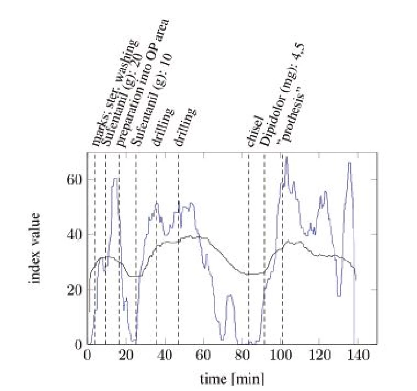 SAI baseline (blue) compared with ANI baseline (black) with particular, painful events (tA10).