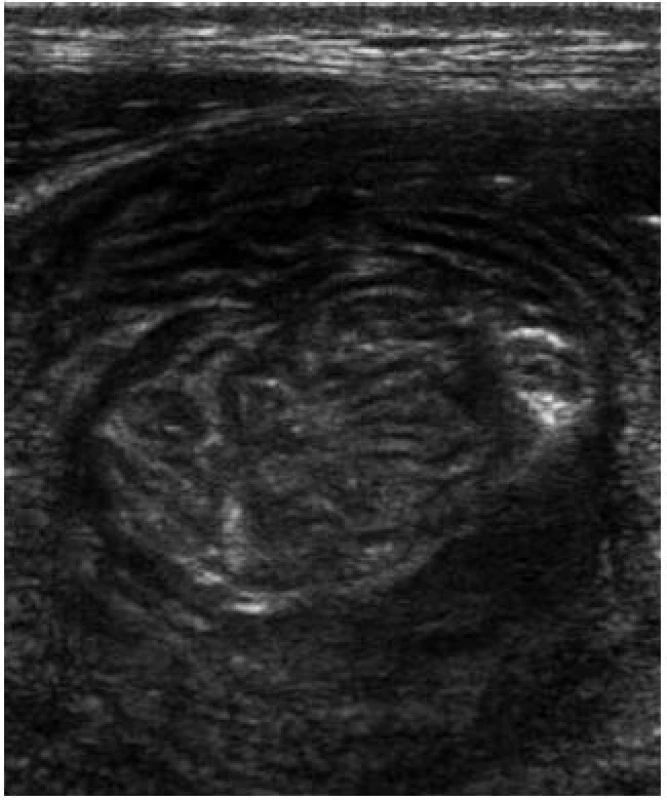 Celiakální sprue – intermitentní invaginace.
Fig. 7. Celiac sprue – intermittent invagination.