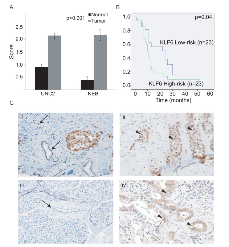 Significance of KLF6 and Fos B expression in primary PDAC.