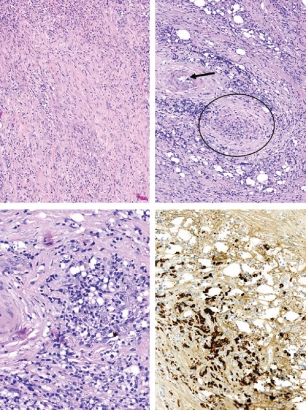 Histologické znaky onemocnění asociovaného s IgG4.
