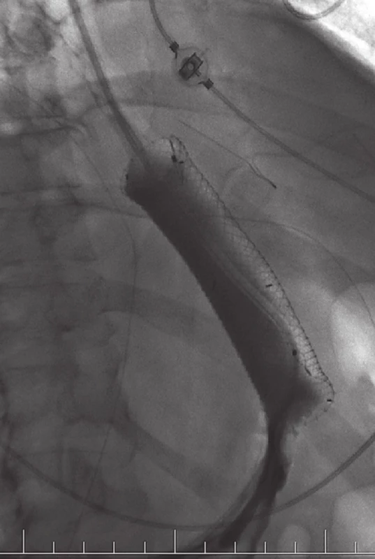 Zavedený samoexpandibilní metalický stent
Fig. 3. Inserted self-expandable metallic stent