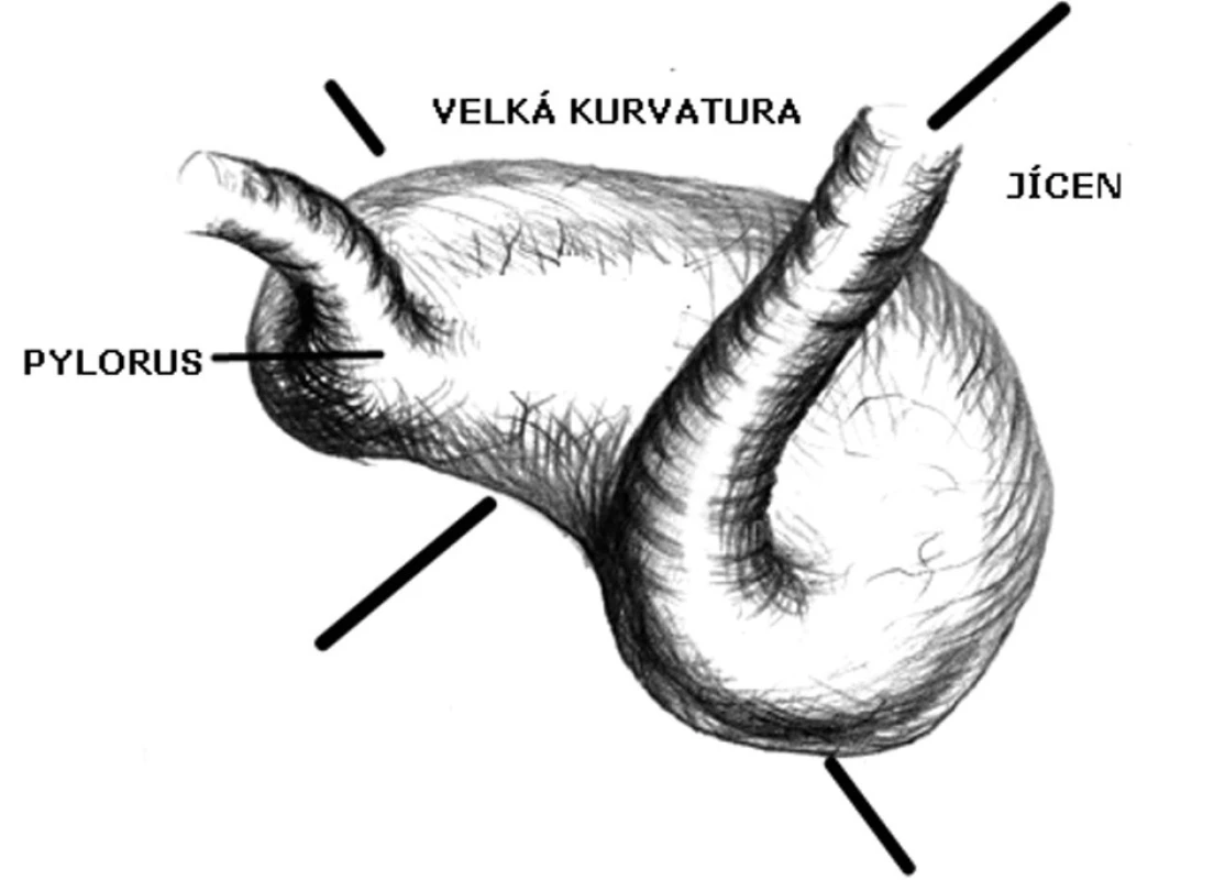 Kombinovaná organoaxilání a mezenteroaxiální rotace
Fig. 5: Organoaxial and mesenteroaxial combined rotation