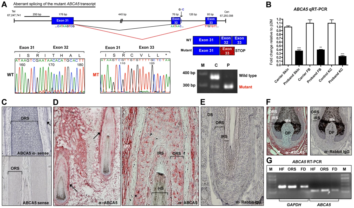 The <i>ABCA5</i> c.4320+1G>C mutation leads to aberrant splicing and nonsense mediated decay, and <i>ABCA5</i> is abundantly expressed in the skin and hair follicle.
