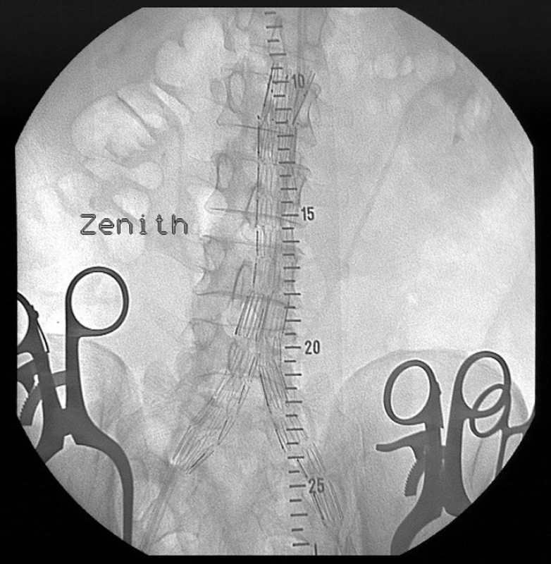 Digitální subtrakční angiografie dolních končetin s viditelným aneuryzmatem podkolenní tepny vlevo.
Pic. 2. Digital subtraction angiography of lower extremities with visible left popliteal artery aneurysm.