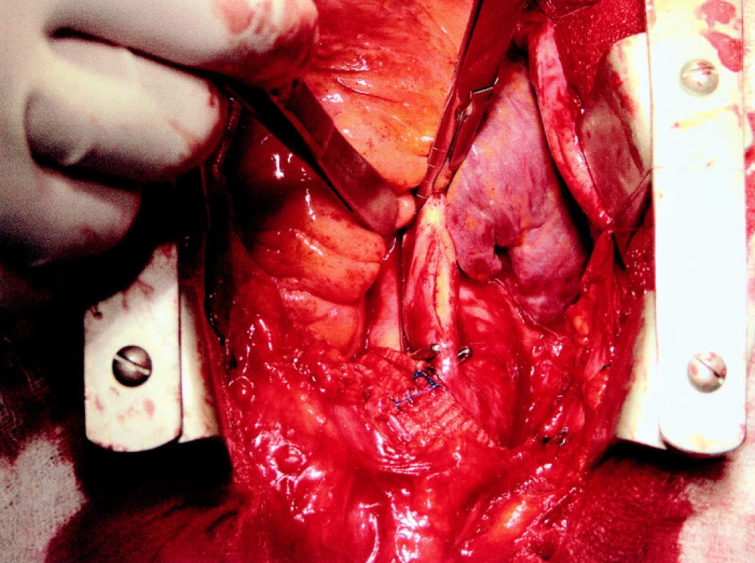 Wall clamp and longitudinal aortotomy
Obr. 2. Aortická svorka a longitudinální aortotomie
