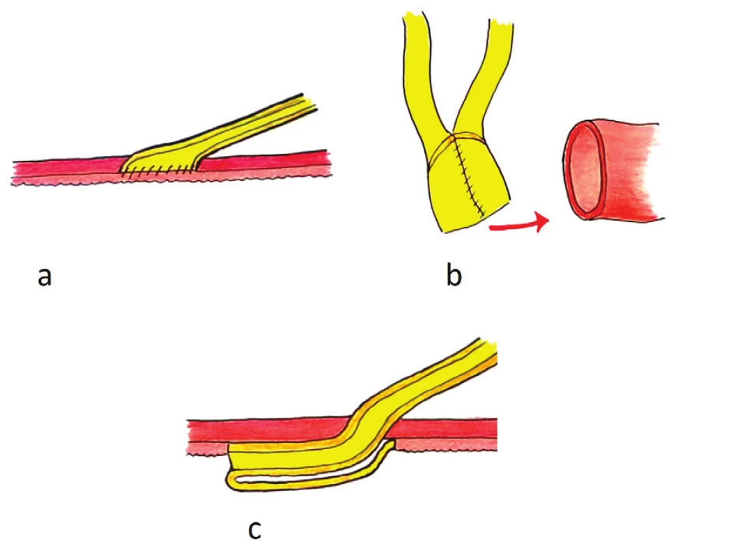Ureterointestinální anastomózy: a) přímá eliptická anastomóza dle Nesbita, b) anastomóza dle Wallaceho, typ 1 (head-to-head), c) antirefluxní anastomóza „flap-and-trough“ dle Doležela
Fig. 1: Uretero-intestinal anastomoses: a) Nesbit, b) Wallace, c) I Flap-and-Trough