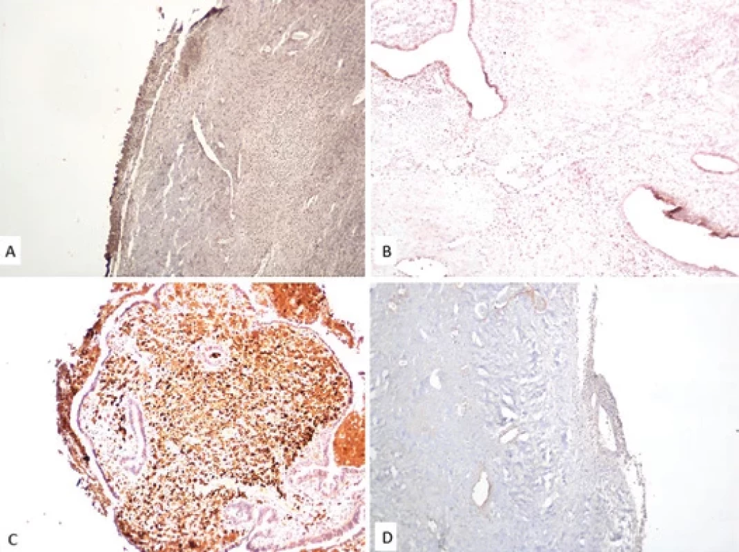 Histological section of endometriomas, showing immunohistochemical staining of polyclonal anti-TNF-α (A, 100×); polyclonal anti-IL-6 (B, 100×); polyclonal anti-IL-8 (C, 100×); polyclonal anti-IL-5 (D, 100×).