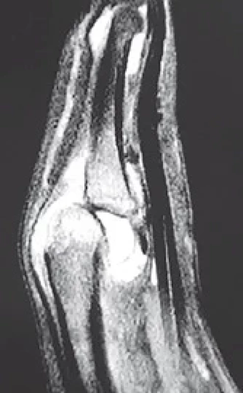 Preoperative MRI: volar subluxation of the basis of the proximal phalanx.