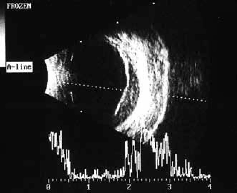 Pacientka č. 1: Ultrasonografie oka pravého: krvácení retrovitreální a intravitreální, hyperechogenní linie odpovídá neúplně odchlípené zadní sklivcové membráně.