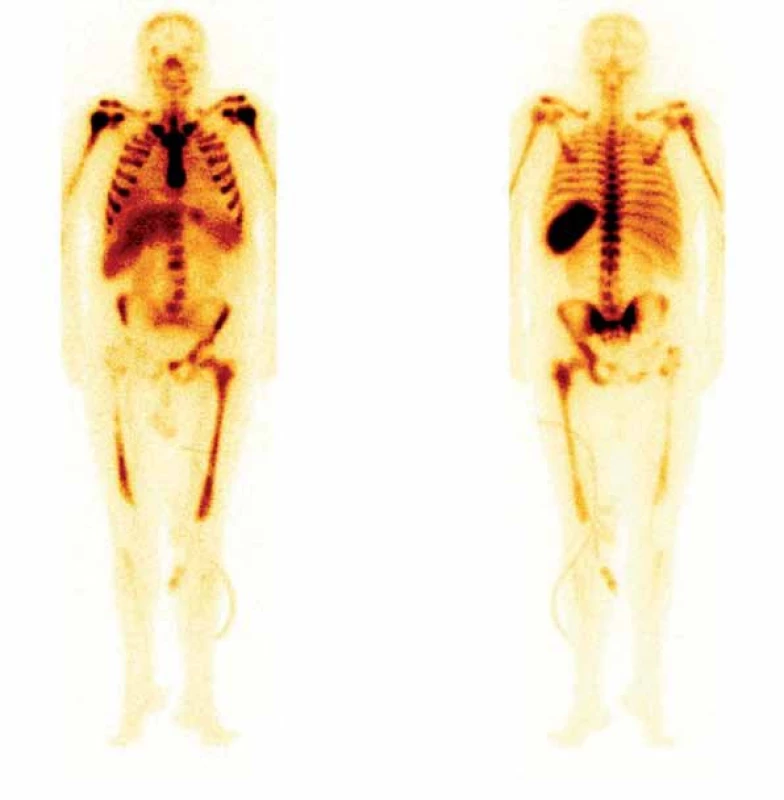 Celotělová scintigrafie skeletu po aplikaci 700 MBq radiofarmaka 99mTc- -besilesomab (značená monoklonální protilátka se specifickou vazbou na antigen NCA-95 nacházející se na buněčné membráně granulocytů a granulocytárních prekurzorů). Výpad záchytu radiofarmaka v pravé polovině těl obratlů L3 a L4, dolní polovině pravé lopaty kyčelní, pravé sedací a stydké kosti. Výrazně je též snížen záchyt v proximální třetině pravého femuru. Fotopenie svědčí pro těžké poškození kostní dřeně, vzhledem k anamnéze nejspíše osteomyelitidou.
