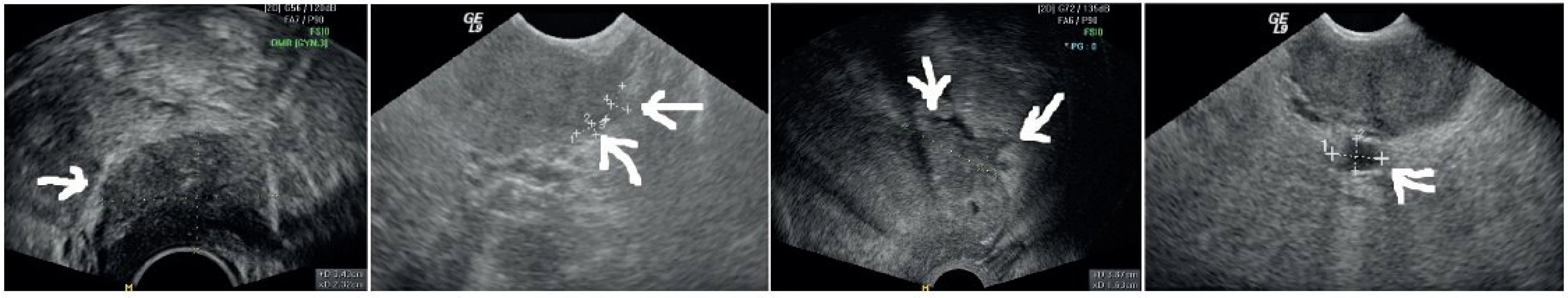 Staging infiltrace parametrií (podle [17])