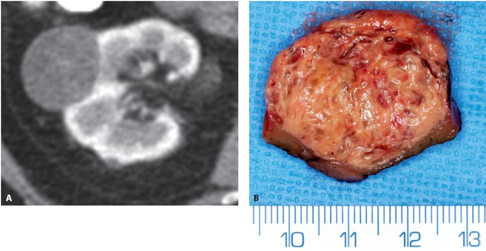 Translokační RK Xp11.2 ASPL-TFE3 na konvexitě prvé ledviny T1bN0M0 u 75leté ženy. A – CT ve venózní fázi, poměrně homogenní tumor s denzitou kolem 70 HU, B – preparát resekátu
Fig. 3. Translocation RCC Xp11.2 ASPL-TFE3 on the convexity of the right kidney T1bN0M0 in 75-year-old woman. A – CT in venous phase, relatively homogenous tumour with a density of about 70 HU, B – specimen at the time of surgery.