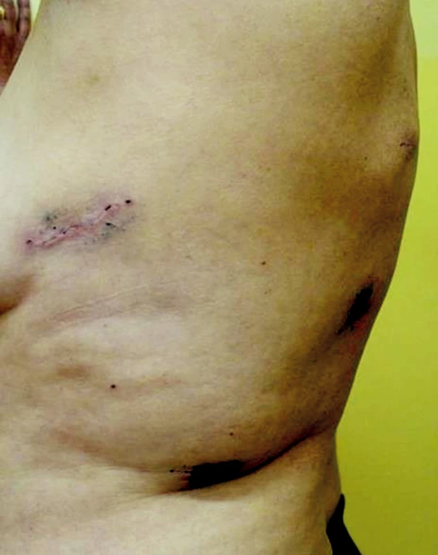Jizvy po torakoskopické horní lobektomii vlevo –14 dnů po operaci
Fig. 1. Scars resulting from upper thoracoscopic lobectomy on the left- 14th postoperative day