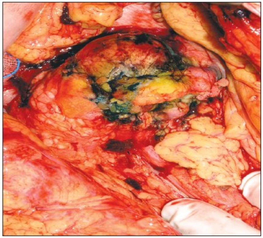 Stejný tumor po provedení RFA
Fig. 2. The same tumor following the RFA procedure