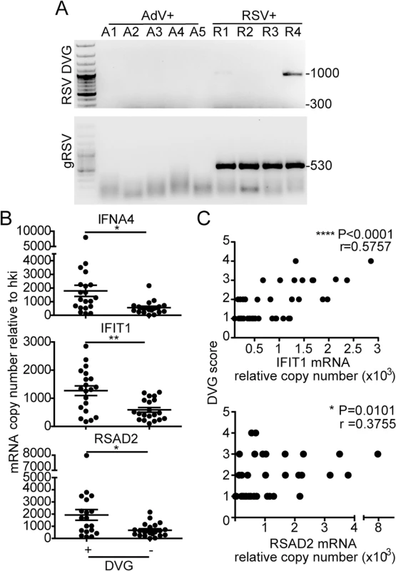 iDVGs associate with high expression of antiviral genes in respiratory secretions from patients infected with RSV.
