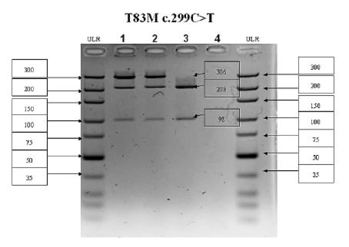 PCR-RFLP analýza 5. exónu ALPL génu 
V prípade mutácie c.299C>T(T83M) zaniká štiepne miesto Hpy-CH4IV. PCR produkt má veľkosť 306 bp, v prípade štandardnej wildtype (WT) alely vznikajú fragmenty 208 a 98 bp, v prípade mutovanej alely (MUT) fragment ostáva neštiepený 306 bp.
Dráha č. 1 – pacientka 1 (WT/MUT), dráha č. 2 – pacientka 2 (WT/MUT), dráha č. 3 – kontrolná vzorka (WT/WT), dráha č. 4 – negatívna kontrola; ULR – marker molekulovej hmotnosti 