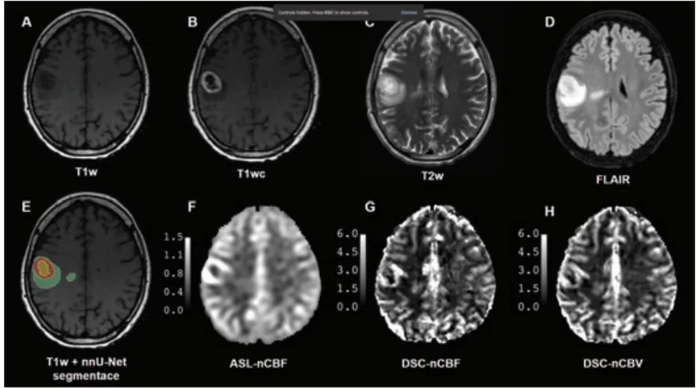  Padesátiletá pacientka s glioblastomem, grade 4 (IDH-wildtype, 1p/19q non-co-deleted, MGMT-methylated, pTERT-mutant).(A) Pre-kontrastní T1-vážený obraz. (B) Post-kontrastní T1-vážený obraz. (C) T2-vážený obraz. (D) T2-FLAIR. (E) T1-vážený obraz s automatickou segmentací pomocí nnU-Net [40]. (F) ASL-CBF mapa normalizovaná na normálně vypadající šedou hmotu (3D PCASL, single-
-PLD). (G) DSC-CBF mapa normalizovaná na normálně vypadající bílou hmotu. (H) DSC-CBV mapa normalizovaná na normálně vypadající bílou hmotu. Obrázek je převzatý se svolením autora [33]. Fifty-year-old female patient with glioblastoma, grade 4 (IDH-wildtype, 1p/19q non-co-deleted, MGMT-methylated,
pTERT-mutant). (A) Pre-contrast T1-weighted image. (B) Post-contrast T1-weighted image. (C) T2-weighted image. (D) T2-FLAIR image.
(E) T1-weighted image with automatic segmentation using nnU-Net [40]. (F) ASL-CBF map normalized to normal appearing gray
matter (3D PCASL, single-PLD). (G) DSC-CBF map normalized to normal appearing white matter. (H) DSC-CBV map normalized
to normal appearing white matter. The fi gure is adapted with permission [33]. 