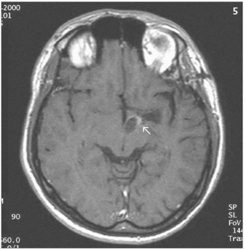 Stejné ložisko 7 let po ozáření – kontrolní MRI – SE T1 po aplikaci kontrastní látky – po provedení stereotaktické punkce cystické části s jejím zmenšením a patrnou sytící se zregredovanou solidní složkou (2000).