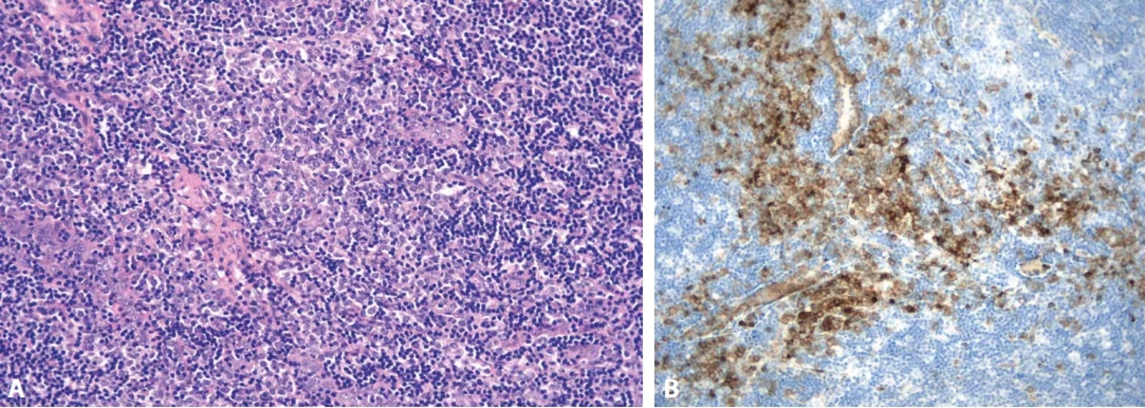 Plazmocytoidní dendritické buňky v okolí zmnožených venul (A, hematoxylin-eosin, 100x). Imunohistochemický půkaz CD123 v PDC (B, zvětšení 100x)