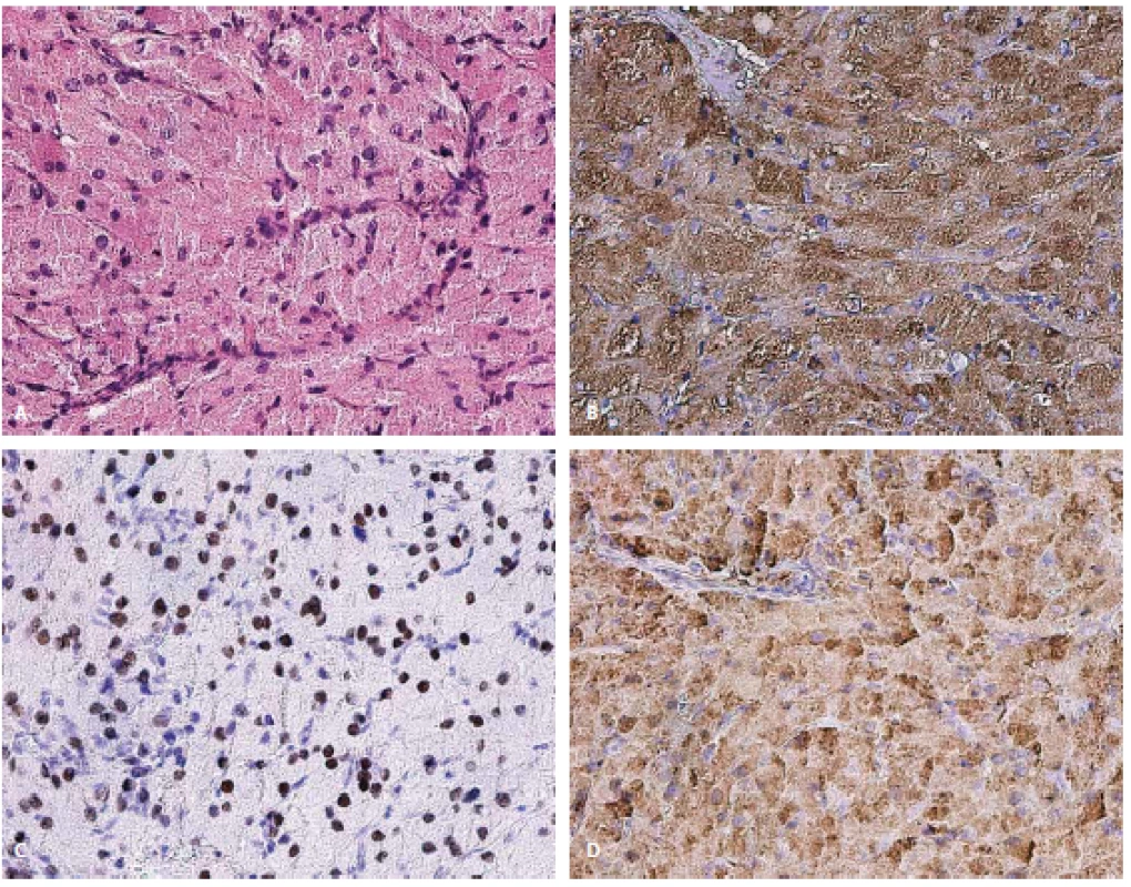 Histologické preparáty nádoru z granulárních buněk. A – barvení hematoxylin–eozin, zvětšení 200×; B – imunohistochemické barvení na antichymotrypsin, zvětšení 200×; C – imunohistochemické barvení na TTF-1, zvětšení 200×; D – imunohistochemické barvení na antitrypsin, zvětšení 200×.
Fig. 2. Histological preparations of the granular cell tumor. A – staining of hematoxylin-eosin, magnification 200×; B – immunohistochemical staining on antichymotrypsin, magnification 200×; C – immunohistochemical staining on TTF-1, magnification 200×; D – immunohistochemical staining on antitrypsin, magnification 200×.