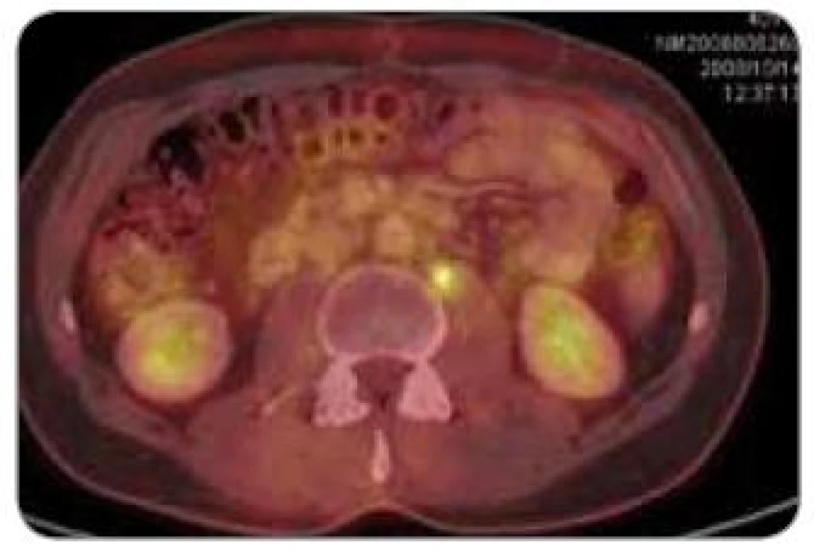 PET + CT – patologické ložisko v retroperitoneu.