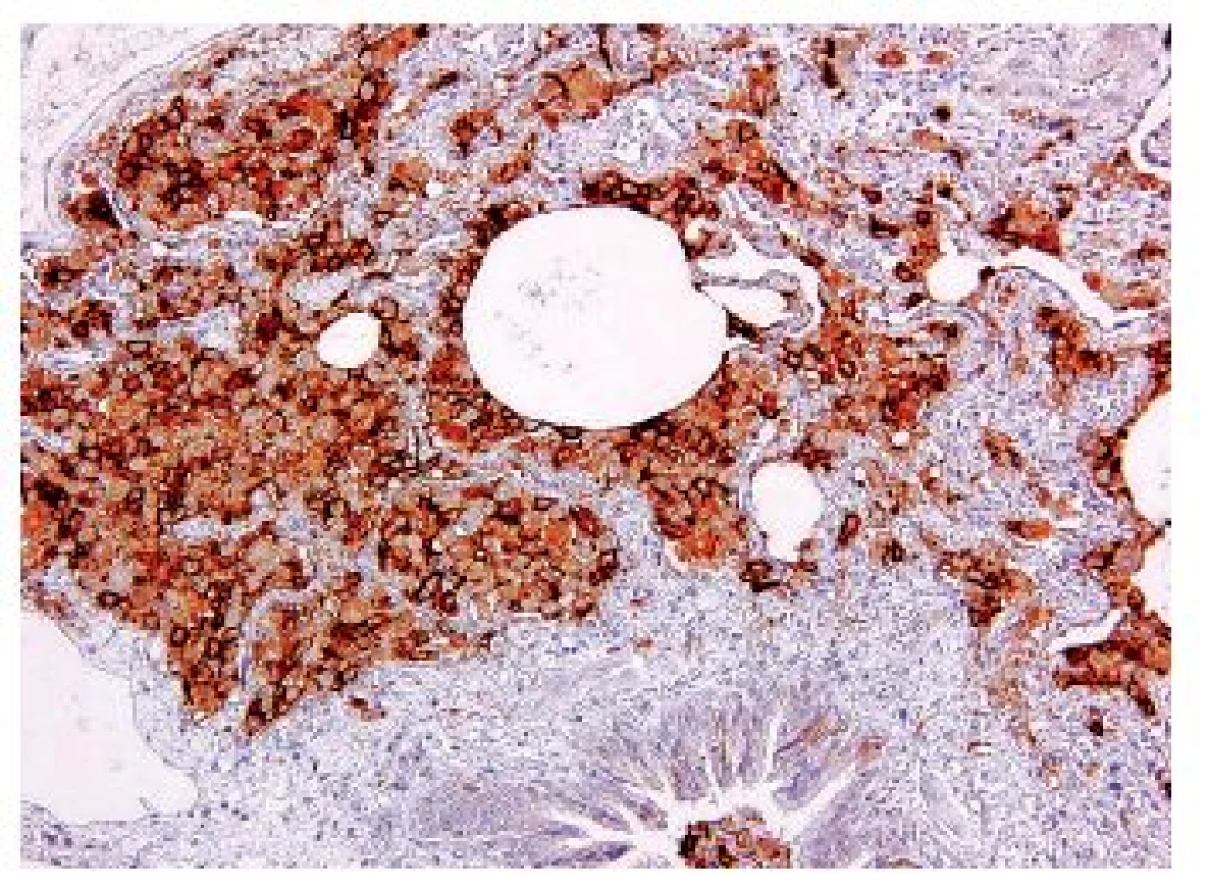 Pozitivita Langerhansových buněk v imunohistochemickém průkazu markeru CD1a -původní zvětšení 200x.