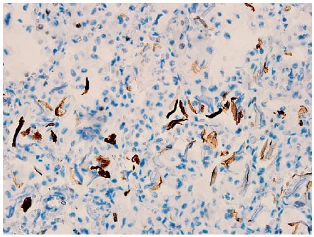 Imunohistochemický dôkaz cytokeratínov 5/6 v skvamóznych epitéliách (imunohistochémia anti-CK5/6, zväčšenie 400x).