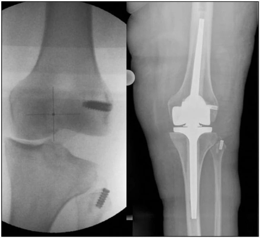(a) Selhání anatomické plastiky (b) Stav po implantaci šarnýrové TEP