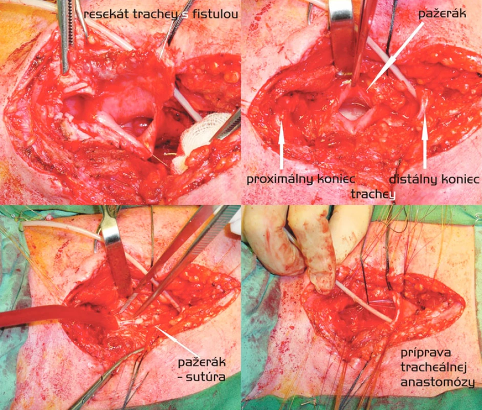 Segmentálna resekcia trachey s anastomózou end-to-end a dvojvrstvová sutúra pažeráka. Postup zľava doprava, zhora nadol
Fig. 2. Segmental tracheal resection with end-to-end anastomosis and a double- layer esophageal suture. Left to right and top to down