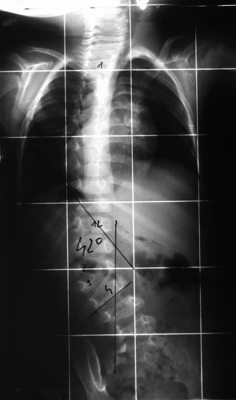 Předoperační zadopřední rtg snímek vrozené skoliózy s poruchou formace třetího bederního obratle.
Fig. 1. Preoperative anterior-posterior X-ray, long spine format of congenital scoliosis with apparent hemivertebra in the area 3rd lumbar vertebra.