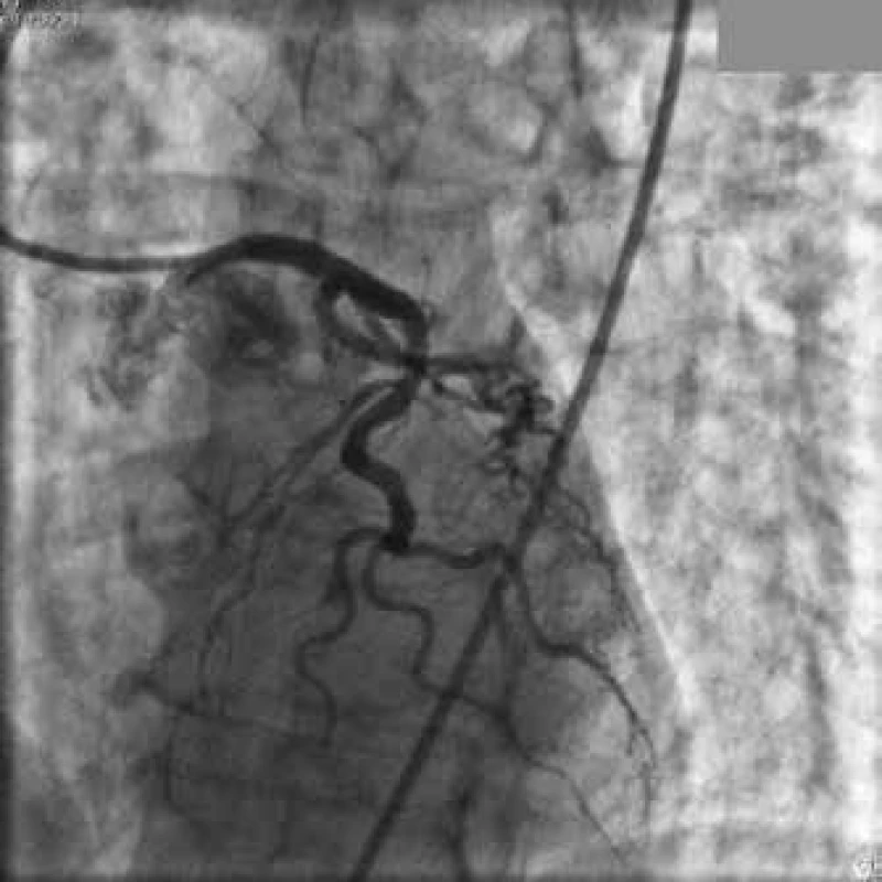 Normální angiogram levé koronární tepny