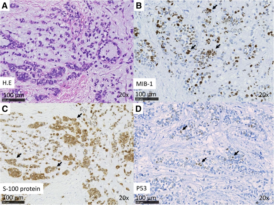 (a–d) Case 2. Histopathologic features of MEC. a H&amp;E stain. b IHC analysis revealed Ki67 positivity in the nuclei. The MIB index was approximately 40 %. c IHC analysis revealed S-100 positivity in the cytoplasm. d IHC analysis revealed p53 positivity in the nuclei