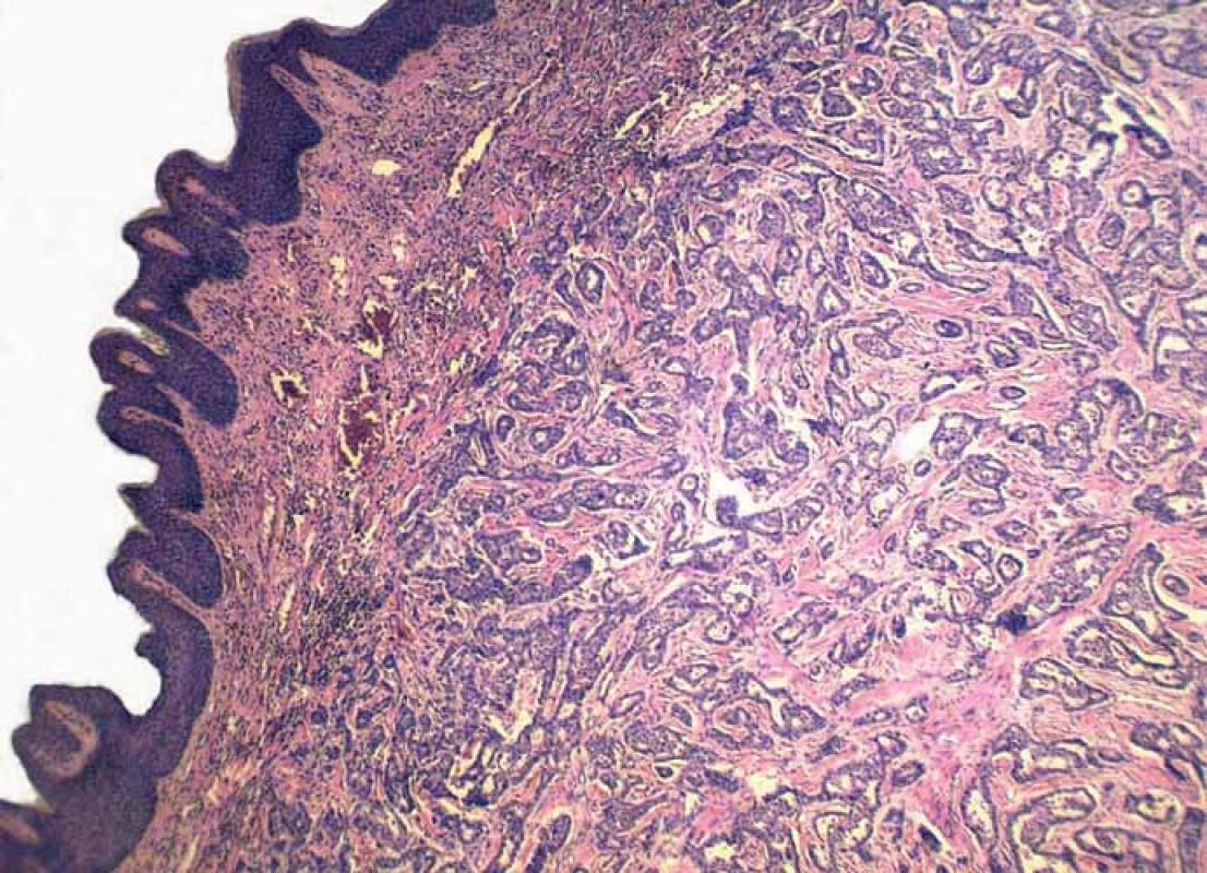 Metastatic infiltration of the dermis, while the epidermis is intact (hematoxylin and eosin, magnification 40×).