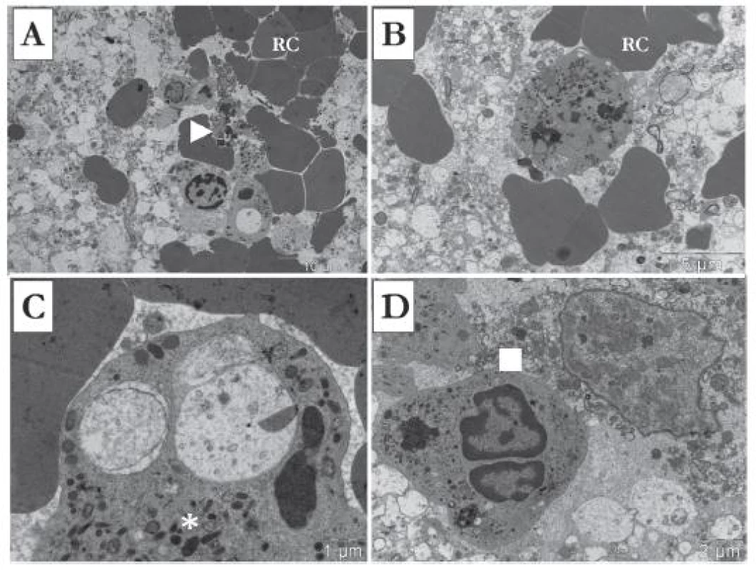 43 years old man who suffered TBI as a car driver. A,B: Extravasation of red blood cells (RC). Oedematous brain tissue. Phagocytosis and lysis of red blood cells, and degranulation of polymorphonuclears. Degranulation of neutrophiles. Lysis of erythrocytes in contusion zone (arrowhead). C: Phagolysosomes, and in cytoplasma there were a large granules, and rod shaped granules (asterisk). D: Signs of neuronophagia. Necrotic neuron surrounded by neurotrophil cells (square).