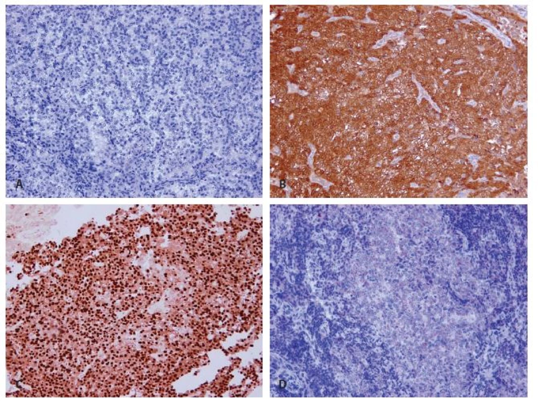 Immunohistochemical findings of recurrent parathyroid carcinoma.
A: Negativity of parathormon (magnifications x 200).
B: Strong difuse cytoplasmatic expression of galectin 3 (magnifications x 200).
C: Focal strong nuclear expression of cyclin D1 (magnifications x 200).
D: Weak cytoplasmatic expression of chromogranin (magnifications x 200).