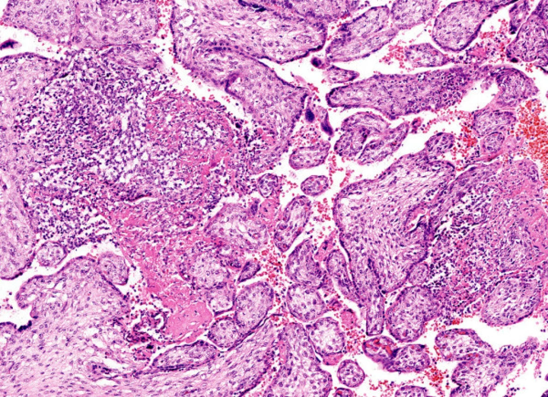 Placenta s akutní vilitidou a intervilózními mikroabscesy (HE, 200krát) 