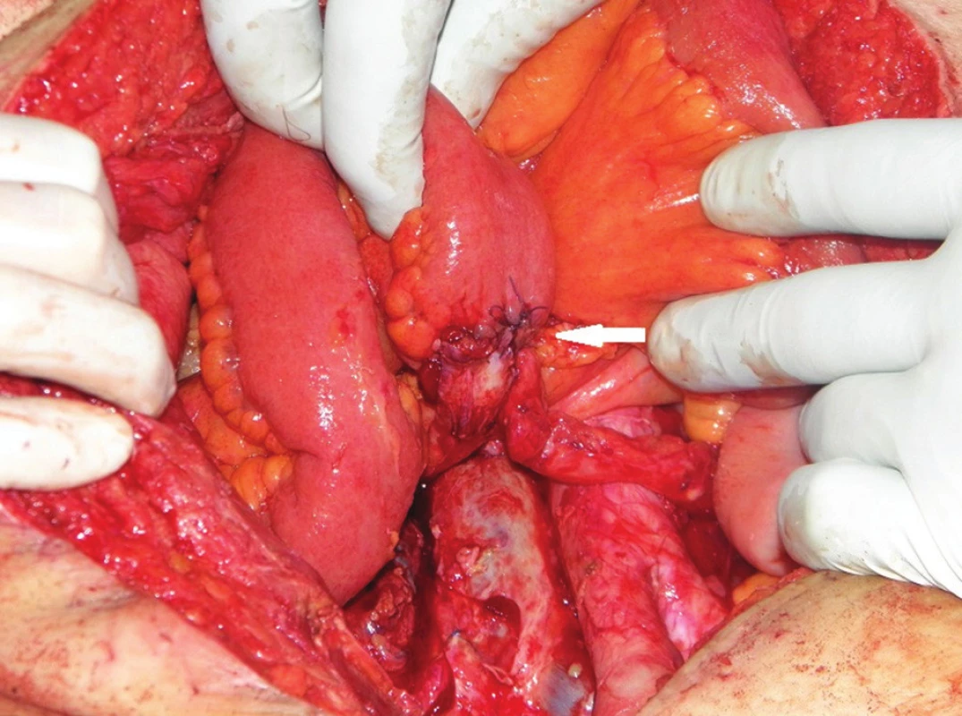 Operační nález: dokončená ureteroileoanastomóza (bílá šipka)
Fig. 6: Surgical finding: finished ureteroileoanastomosis (white arrow)
