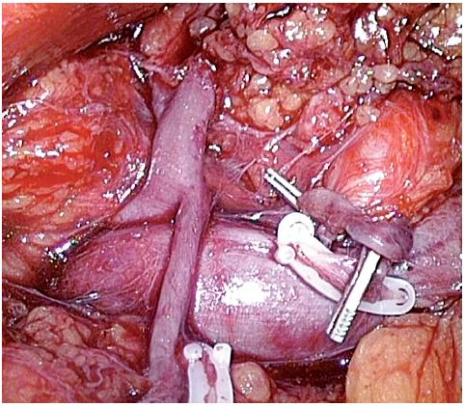 Raritní nález odstupu gonadální žíly z levé suprarenální žíly
Fig. 2. A rare fi nding of the left gonadal vein draining directly into the left suprarenal vein