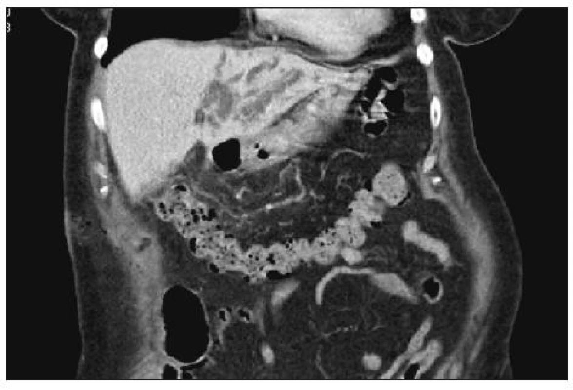 CT obraz dilatace žlučových cest v oblasti 2. a 3. jaterního segmentu
Fig. 5. CT image of bile duct dilatation in area 2<sup>nd</sup> and 3<sup>rd</sup> liver segment