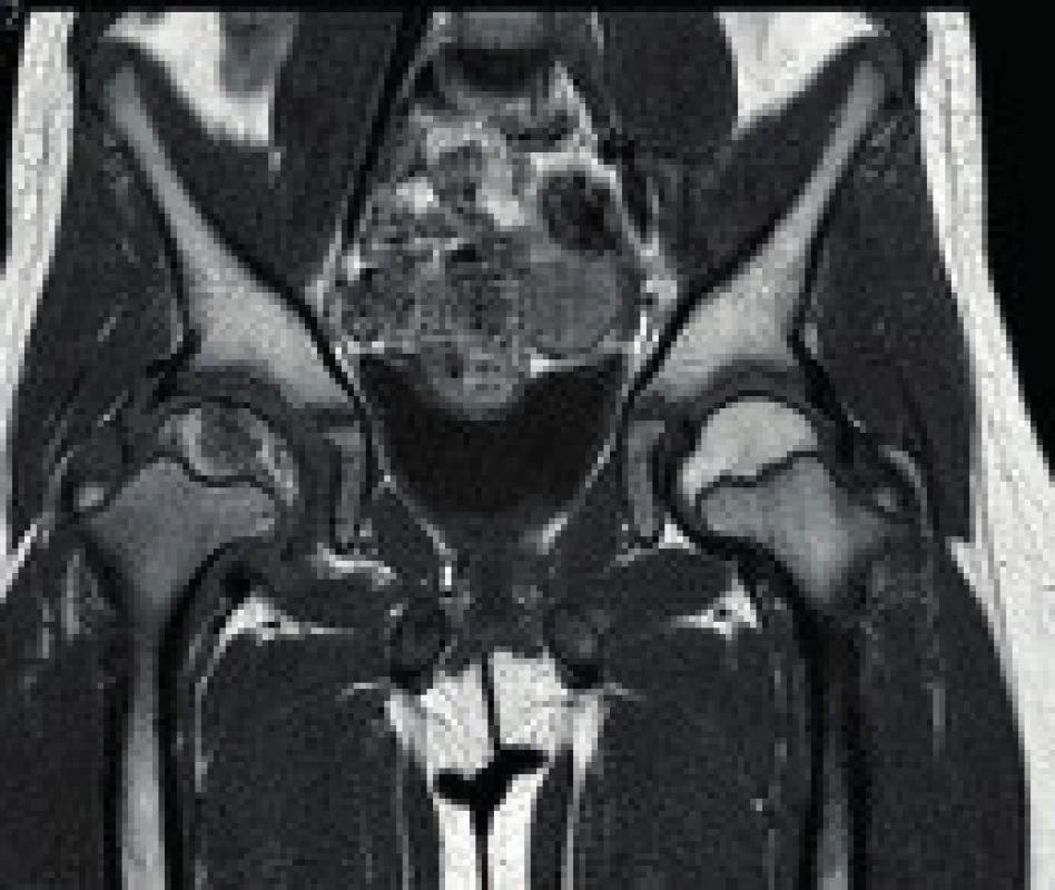 Magnetická rezonance ukazující Perthesovu chorobu pravého kyčelního kloubu.
Fig. 3. MR image showing the affection of the right hip by Perthes disease.