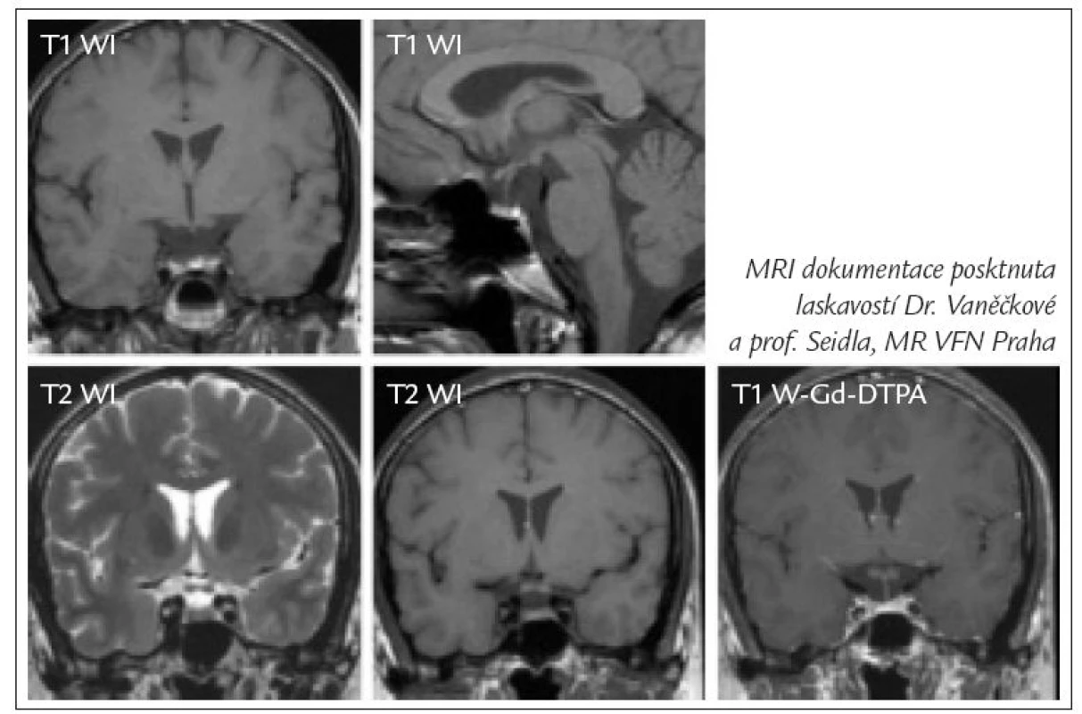 Zdravá hypofýza v MRI.
