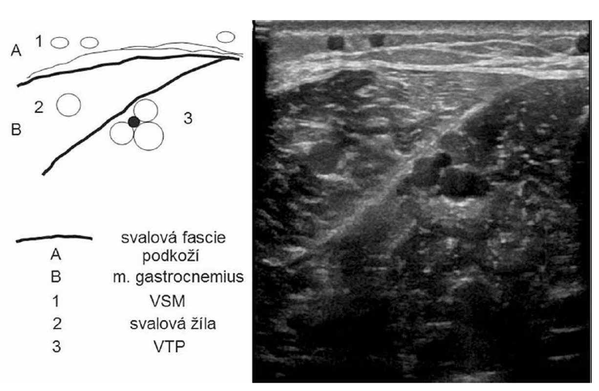 Příčný ultrasonografický řez lýtkem, přes mediální hlavu m. gastrocnemius
