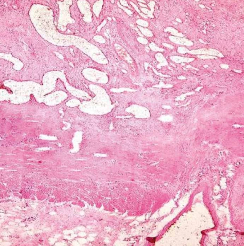 Atypické velké cévy v subseróze.
Fig. 5. Atypical large vessels in subserosa.