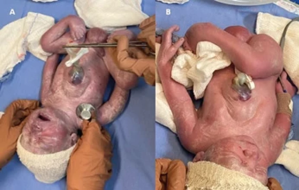Newborn showing a pulsatile mass in the lower chest region covered by skin with extension to the anterior wall of the supraumbilical abdomen, associated with bilateral congenital clubfoot (A, B).