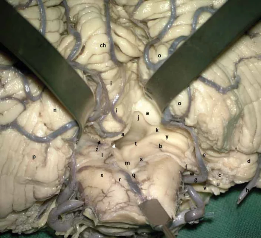 Laboratorní provedení telovelárního přístupu s ozřejměním anatomických struktur fossa rhomboidea a jejího laterálního recessu, cerebellomedullární fi ssury a cisterny. Za povšimnutí stojí například rhombický val (rhomboid lip) nebo telovelární junkce. Tonzily nejsou resekovány, ale odsunuty superolaterálně pomocí retraktorů