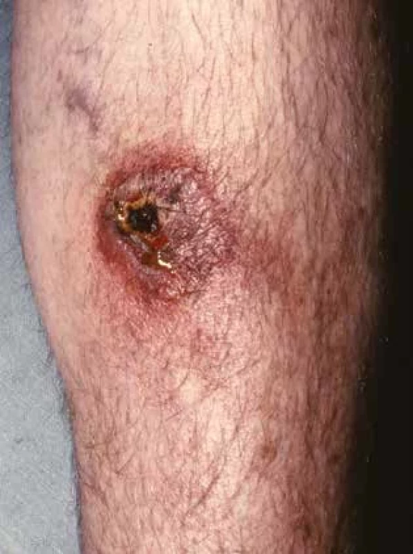 Ecthyma gangrenosum, ostře ohraničený nekrotický defekt s hemoragickou krustou a okolní jemnou purpurou