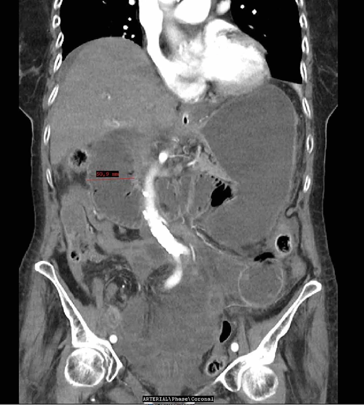 Dilatace duodena   Fig. 4: Dilation of the duodenum