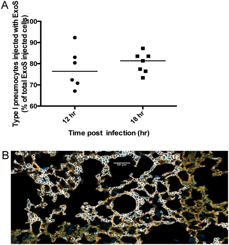 A clinical <i>P</i>. <i>aeruginosa</i> isolates that naturally secretes both ExoS and ExoT also causes formation of FOCI.