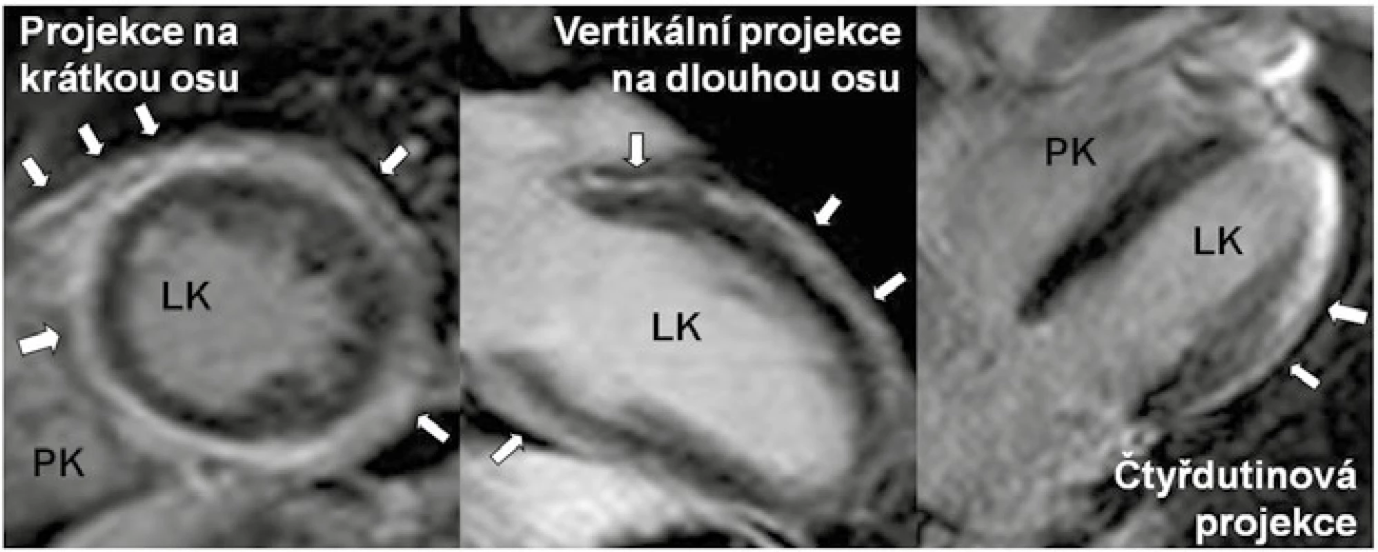 Nález pozdního sycení kontrastní látkou (LGE), tj. fibrózy u arytmogenní kardiomyopatie levé komory