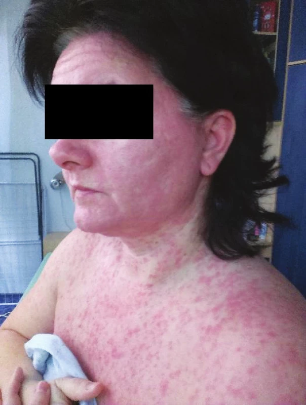 Klinický obraz při příjmu k hospitalizaci na infekční oddělení Masarykovy nemocnice 
v Ústí nad Labem